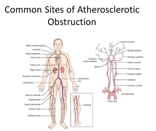 arthosclerosis