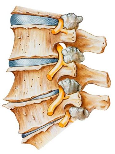 spinal degeneration
